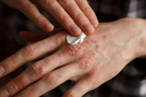 Eczema Cream applying an emollient to dry flaky skin as in the treatment of p Eczema Salve